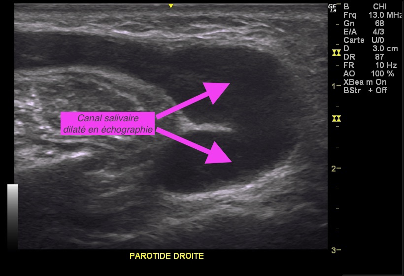 Lithiases -gonflement des glandes salivaires